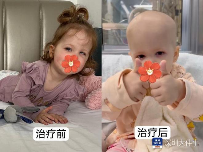 基因治療“逆天改命”！瑞典罕見(jiàn)遺傳病患兒萬(wàn)里赴粵重獲新生(圖2)